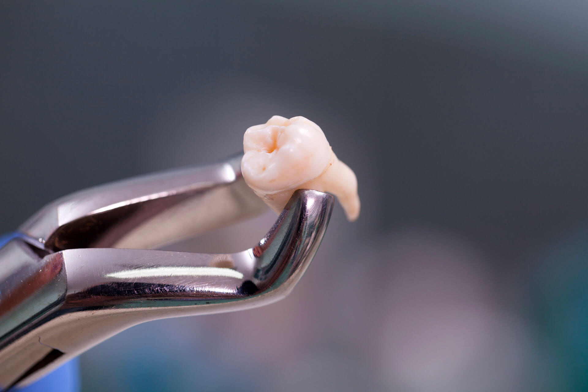 L’extraction des dents de sagesse