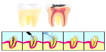 Endodontics : Root Canal Treatment
